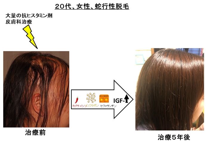 円形脱毛症　病院